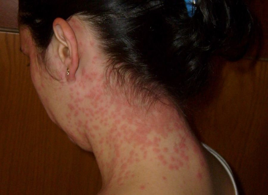 After having a really bad rash , her doctor suggested she uses the rash cream to mitigate the rash.