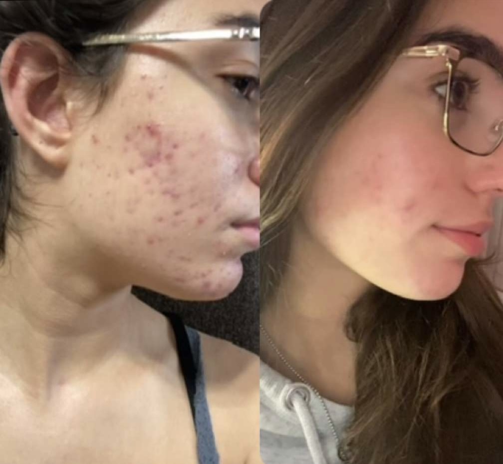 (Left) I started Acctutane in July of 2023, as you can see my acne was severe. (Right) Seven months later, I was coming to an end of my journey.
