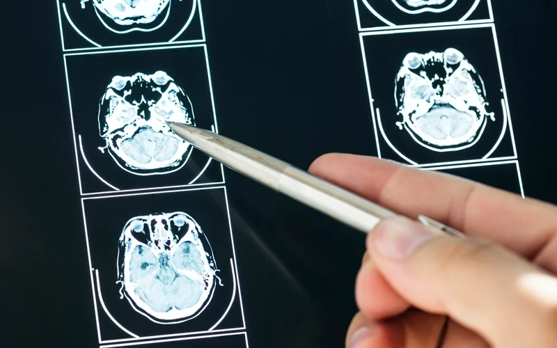 Illustrating the impact of traumatic brain injuries, this brain scan reveals areas of damage often caused by repeated head impacts. Long-term consequences are memory loss, mood disorders, and depression.